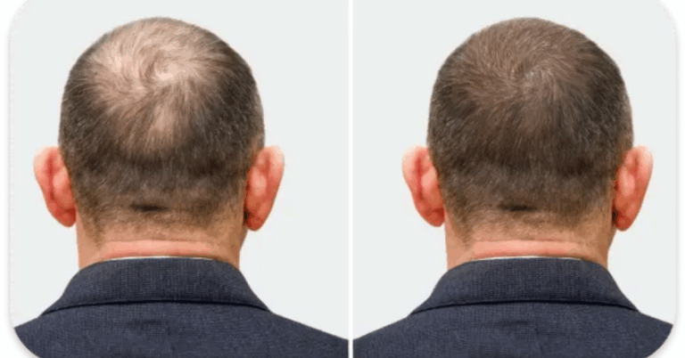 Top Hair Loss Treatment For Men: Complete Guide to Regaining Confidence